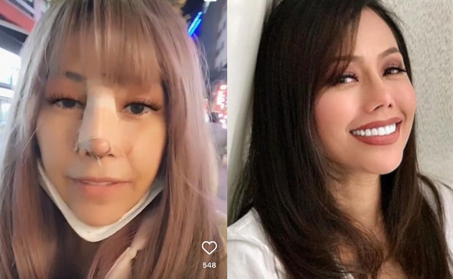 [VIDEO] Buat Pembedahan Hidung Di Korea, Lana Nordin Lega Muka Tak Bengkak