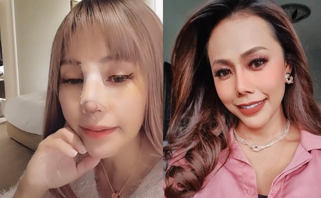 [VIDEO] Kos Hidung Cecah RM166,000, Lana Nordin Guna Tulang Rusuk Untuk Pembedahan Kali Keempat