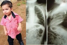 Tertelan Bateri Yang Kini Dah Meletup Dalam Badan, Budak 2 Tahun Bertarung Nyawa Di Hospital