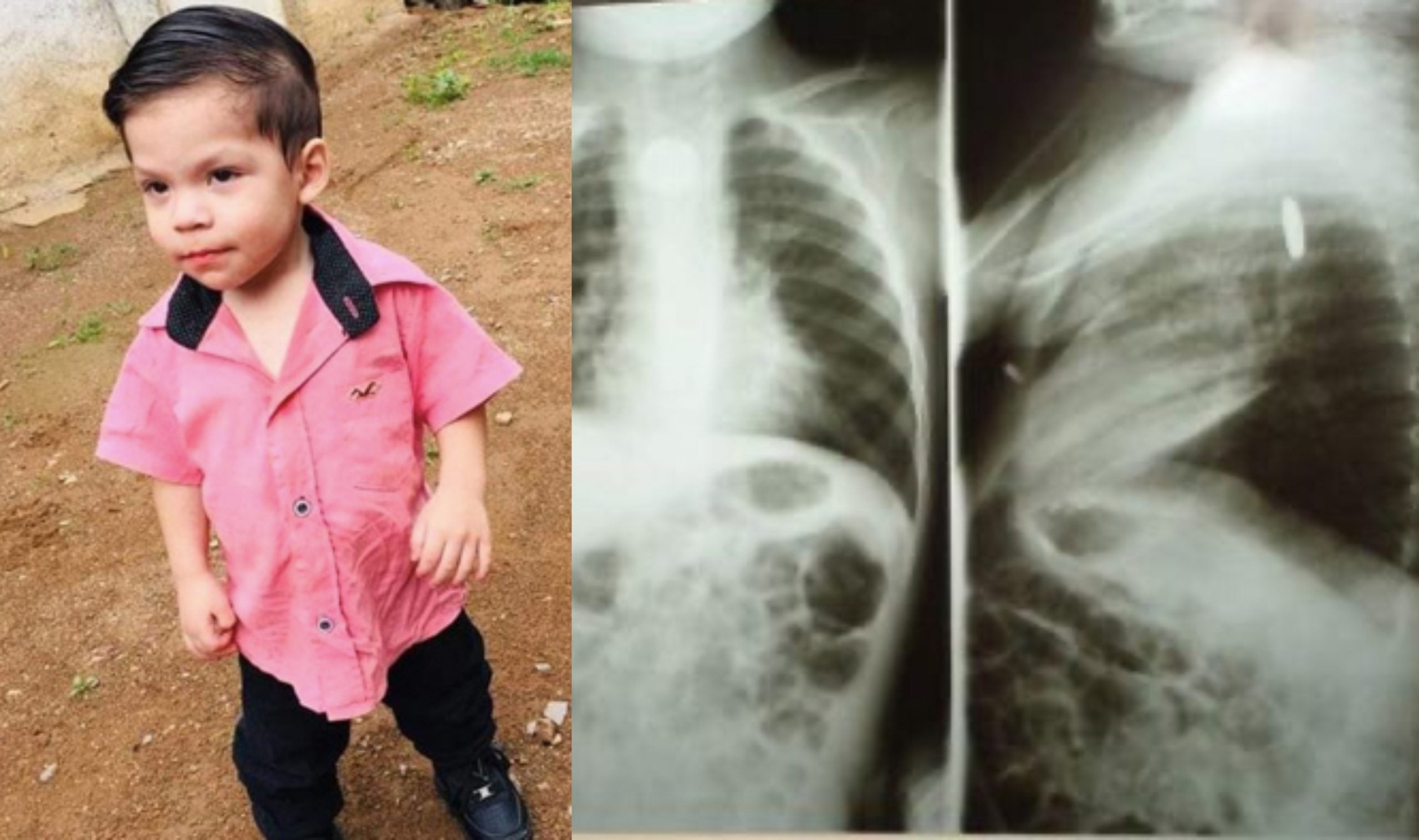 Tertelan Bateri Yang Kini Dah Meletup Dalam Badan, Budak 2 Tahun Bertarung Nyawa Di Hospital