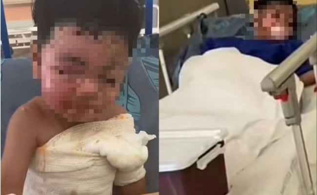 [VIDEO] Sayu Hati Ibu Muka Anak Melecur 70 Peratus Gara-Gara Cawan Ramen Terbalik – ‘Lalai Ya Aku Sebagai Ibu’