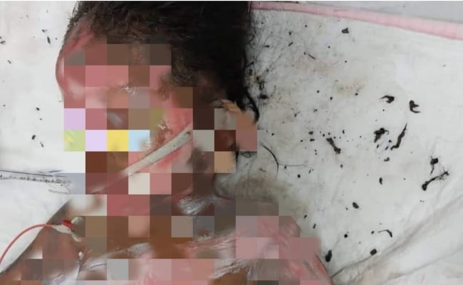 Kanak-Kanak Perempuan Melecur Separuh Badan Main Bunga Api