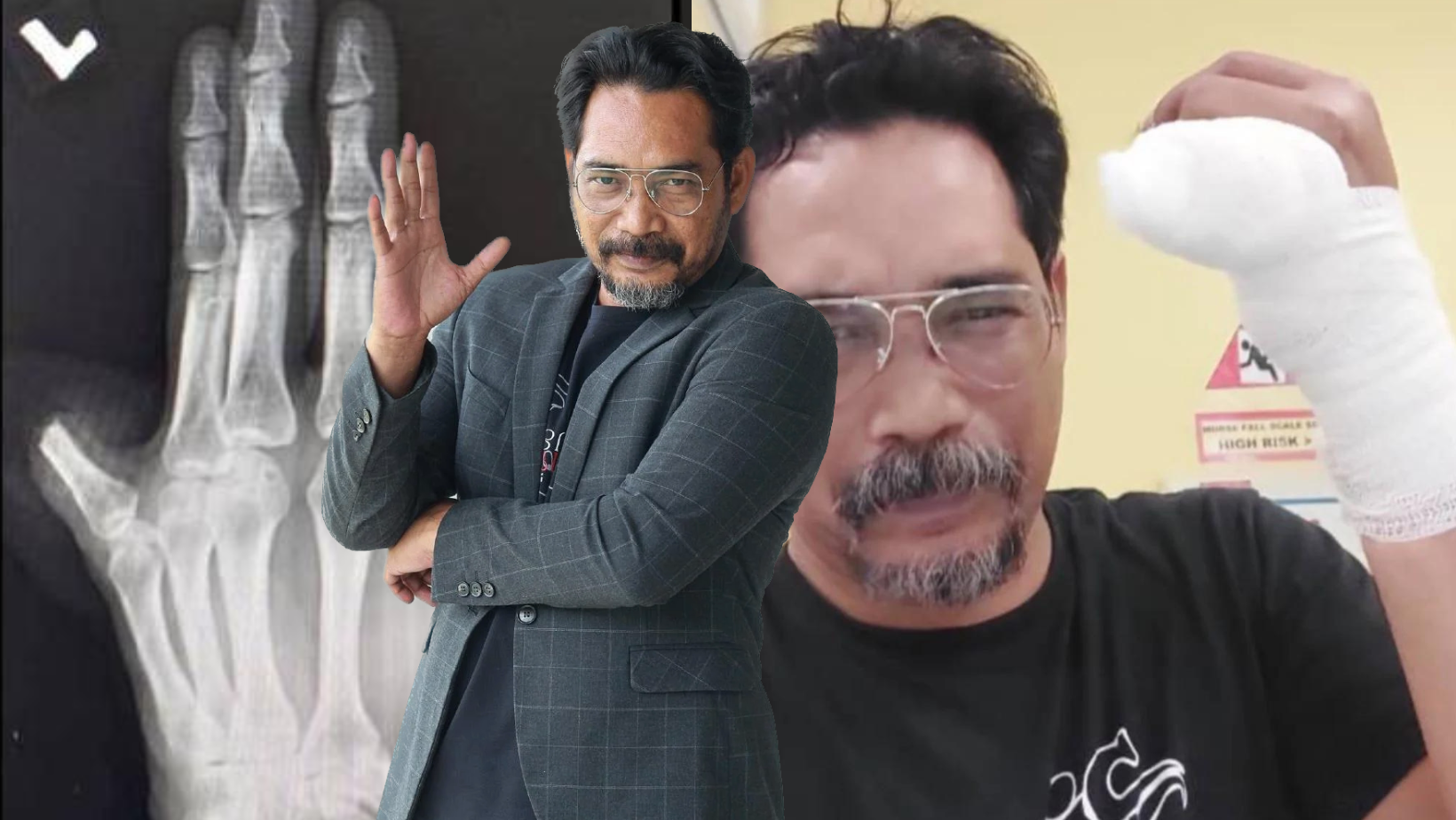 Jari Kelingking Putus, Shahronizam Terkilan Persatuan & Rakan Artis Tak Tanya Khabar -‘Yang Ada Azhan Rani…’
