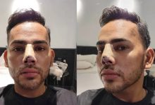 Lelaki Obses Dengan Pembedahan Kosmetik Kini Insaf & Tertekan Selepas Mengalami Kecacatan Hidung