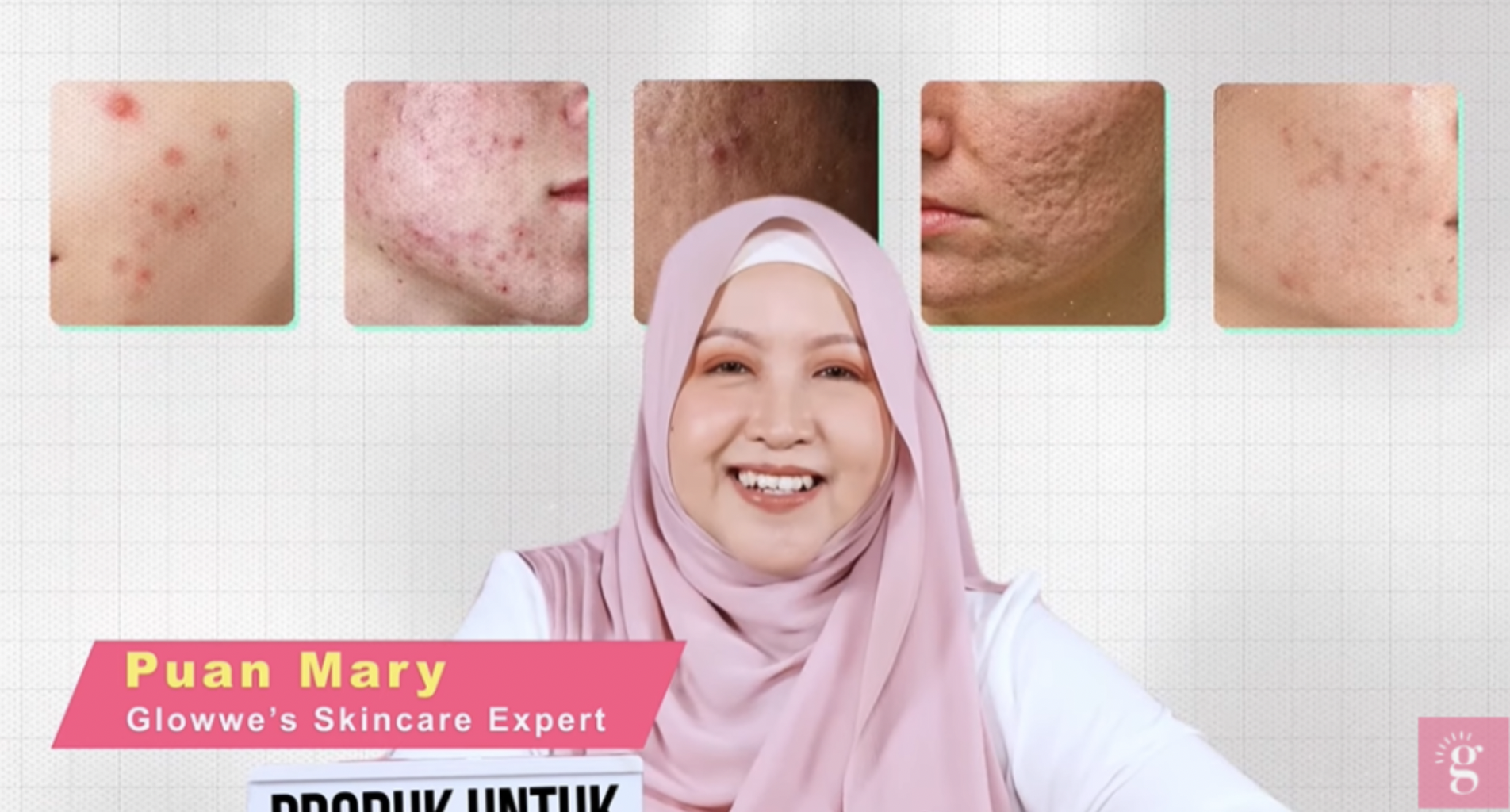 Yes! Kulit Bebas Jerawat Dalam Masa 2 Minggu Beb. Ini Kata Mereka Tentang Eucerin ProACNE Solution!