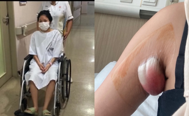 Gara-Gara Pakai Wax, Tumbuh Benjolan Besar Di Ketiak Sehingga Perlu Dibedah