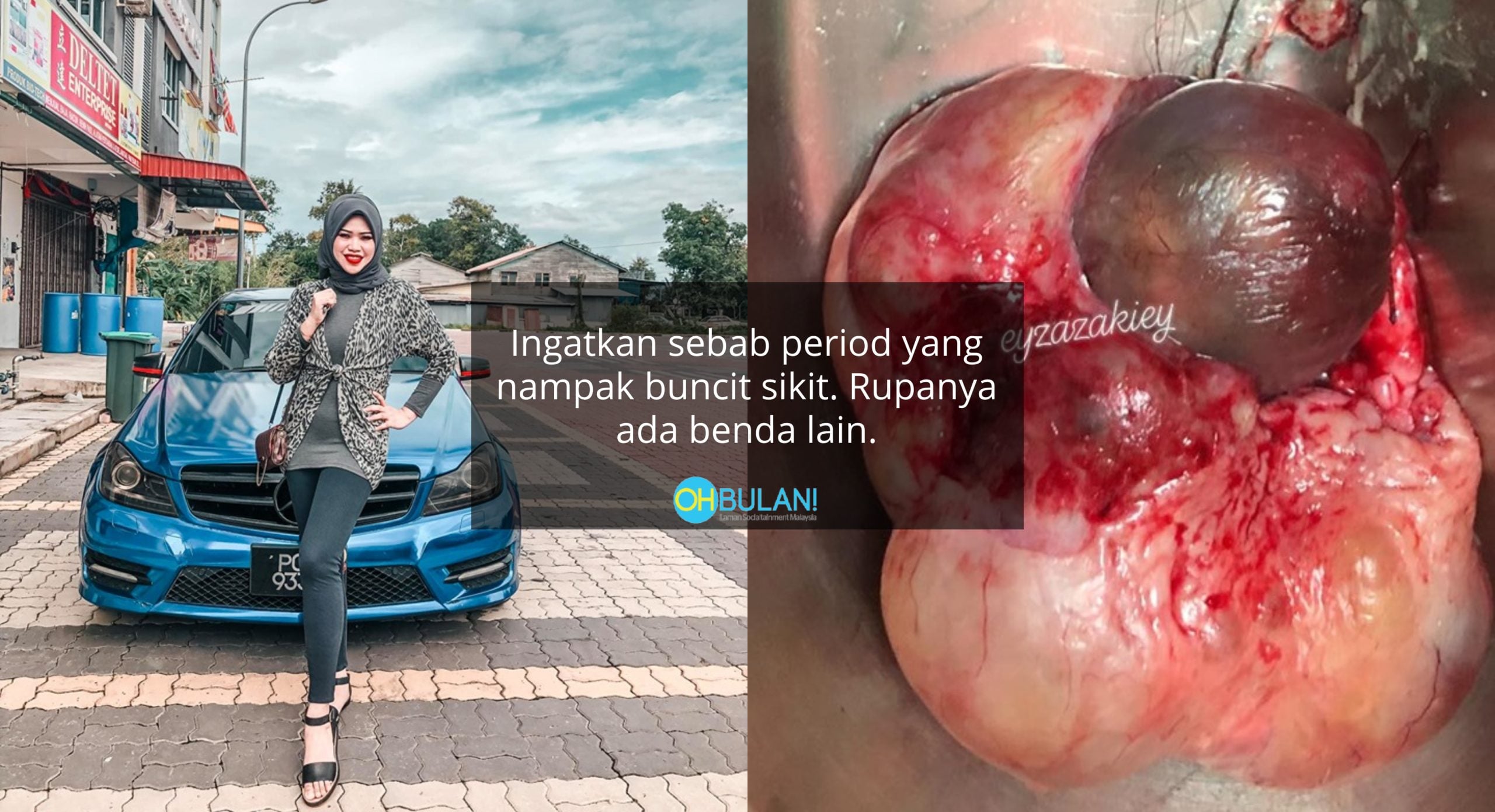 ‘Patutlah Dekat Ari-Ari Selalu Rasa Tegang’ – Wanita Kongsi Pengalaman Buang Cyst, Siap Ada Rambut