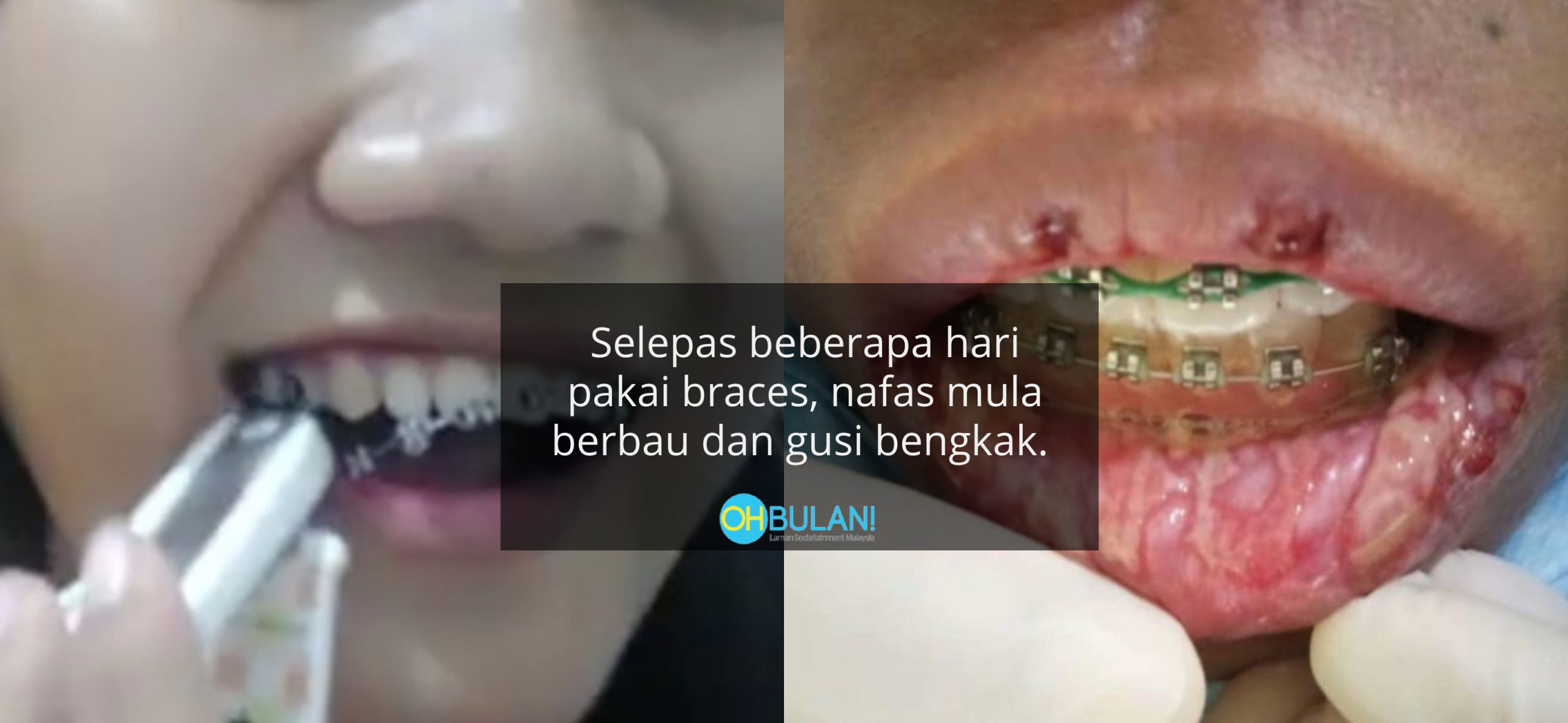 Nafas Berbau, Gam Meleleh Ke Gusi – Remaja Sanggup Cabut Fake Braces Dengan Pengetip Kuku
