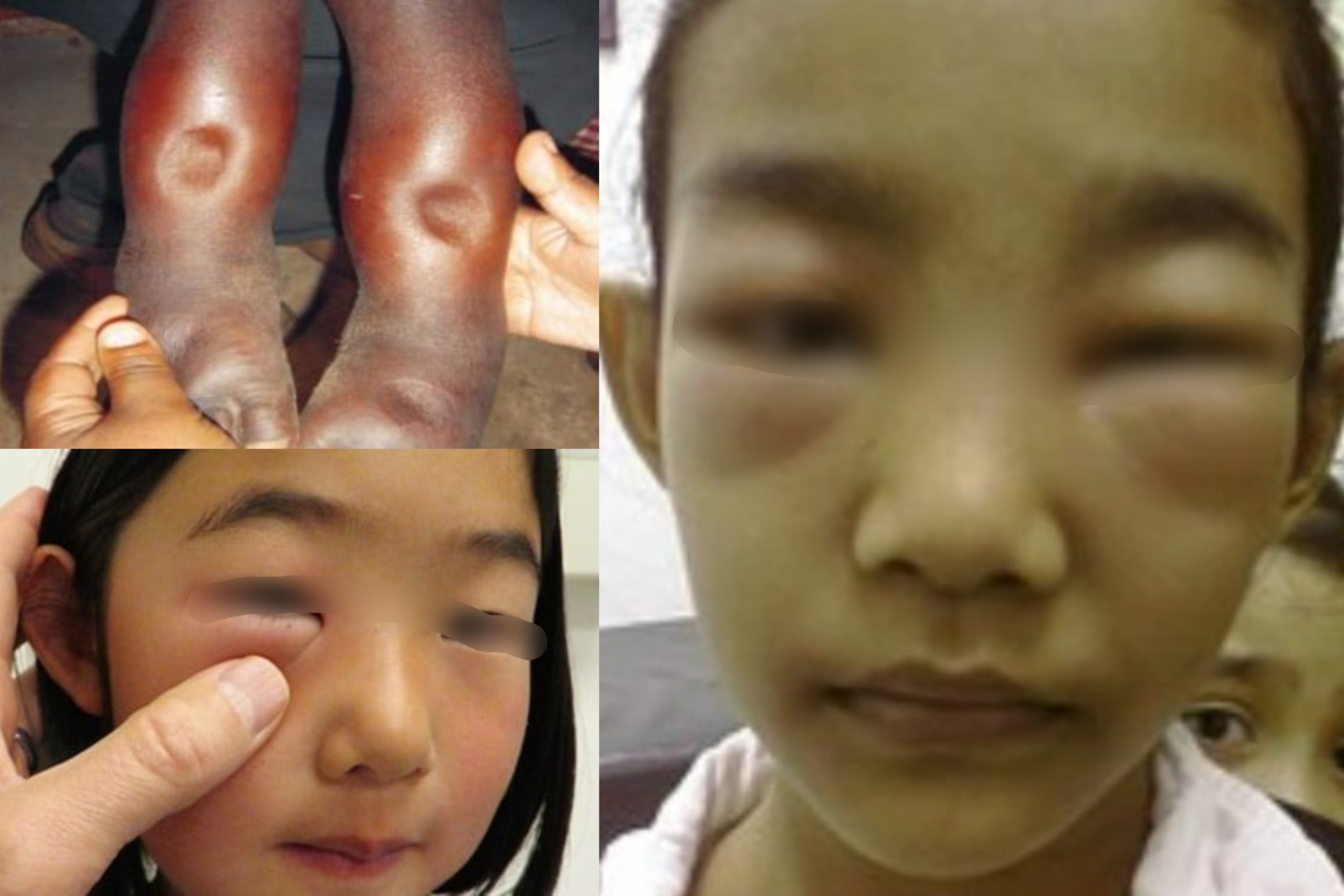 ‘Muka & Kaki Anak Bengkak, Air Kencing Berbuih’ – Doktor Kongsi Tanda-Tanda & Rawatan Sindrom Nefrotik
