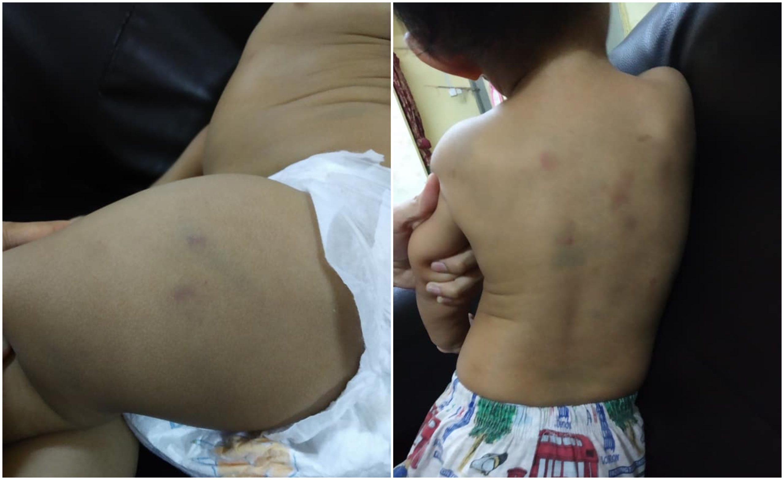 Hari Pertama Anak Dihantar Ke Pusah Asuhan, Badan Anak Penuh Kesan Lebam