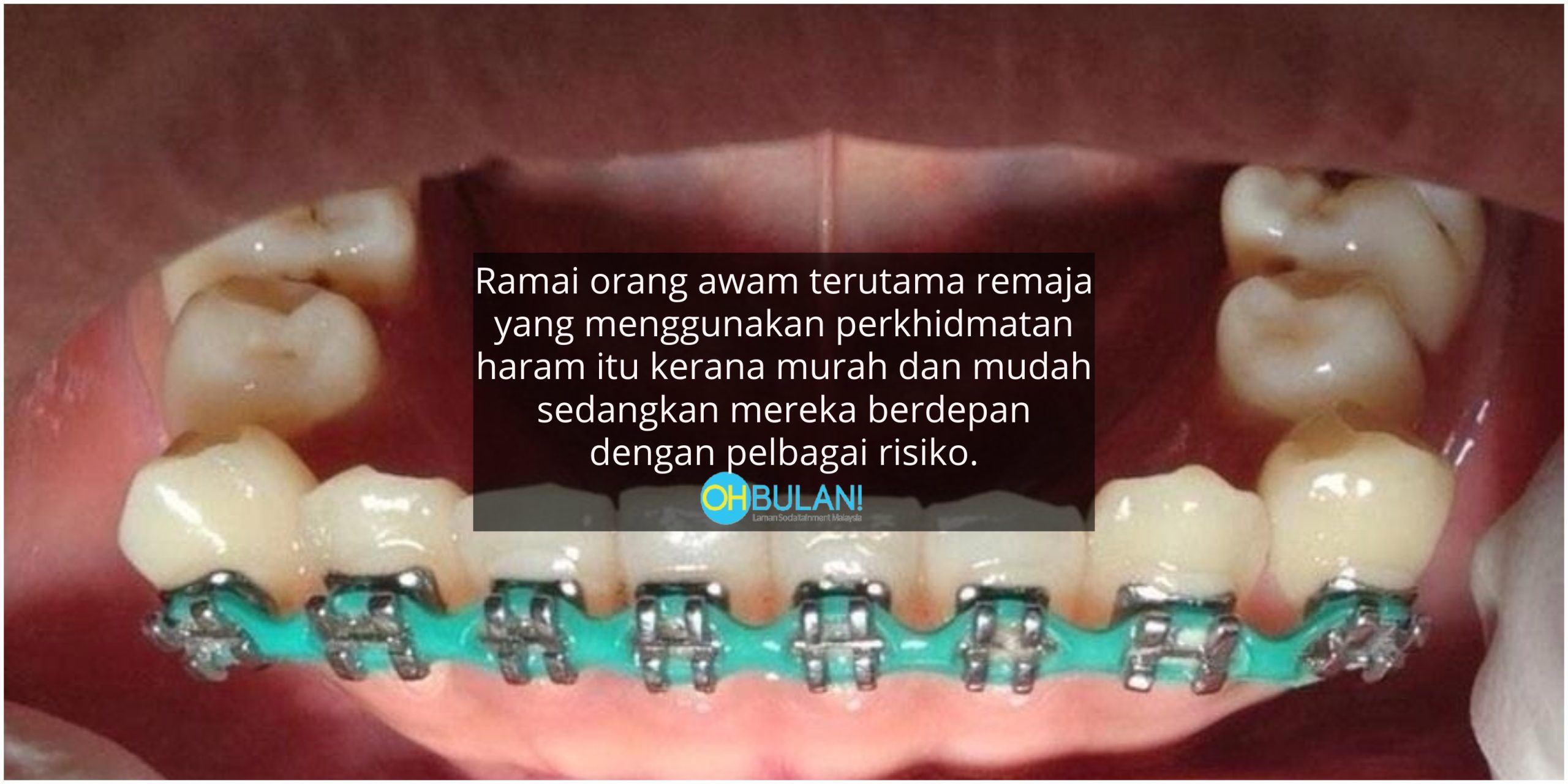 Murah Tapi Berisiko, Pakai Fake Braces Anda Mungkin Dijangkiti HIV