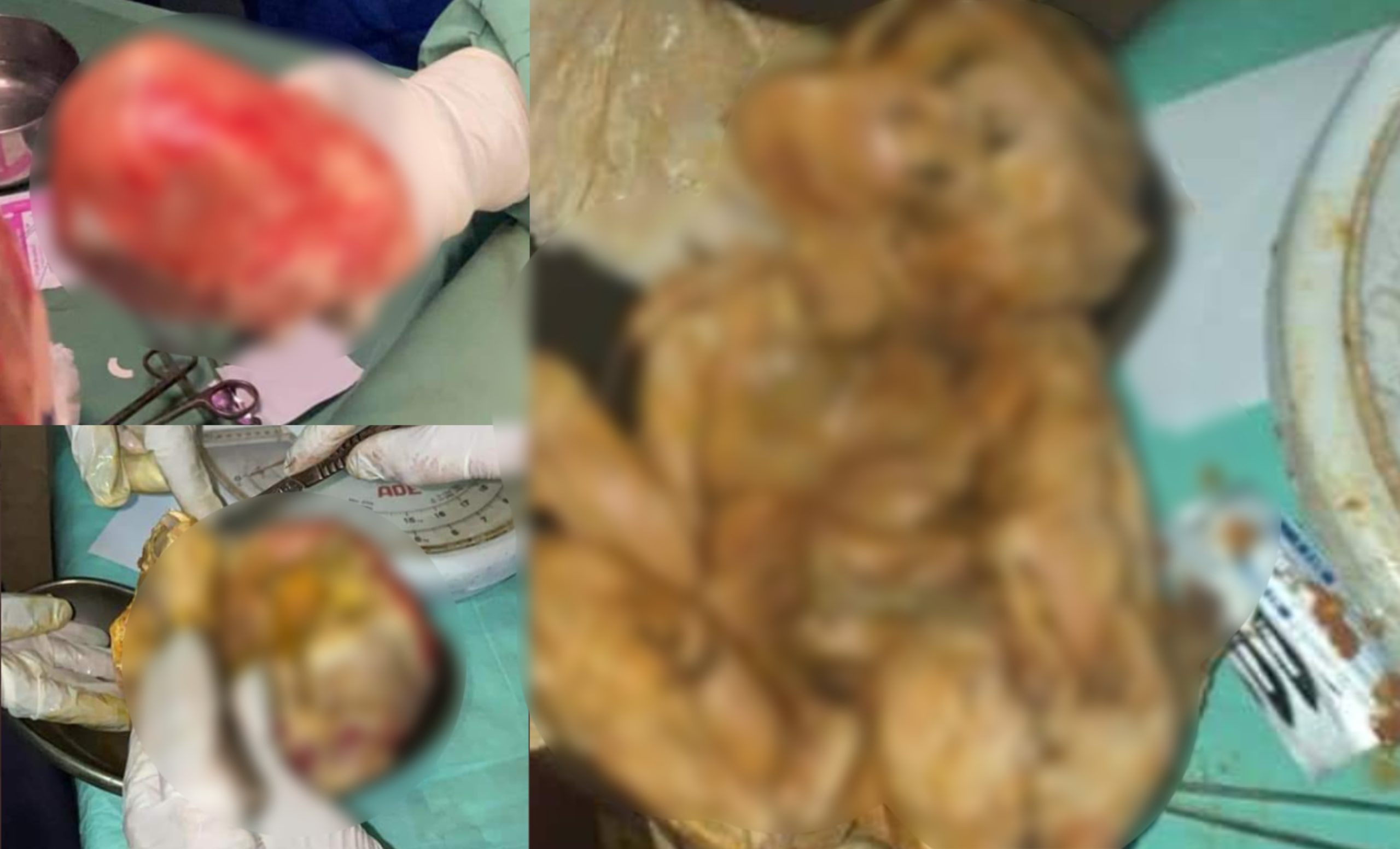 Ibu Tak Sedar Bayi Dah 15 Tahun ‘Tersorok’ Dalam Perut, Bila Diperiksa Rupa-Rupanya…