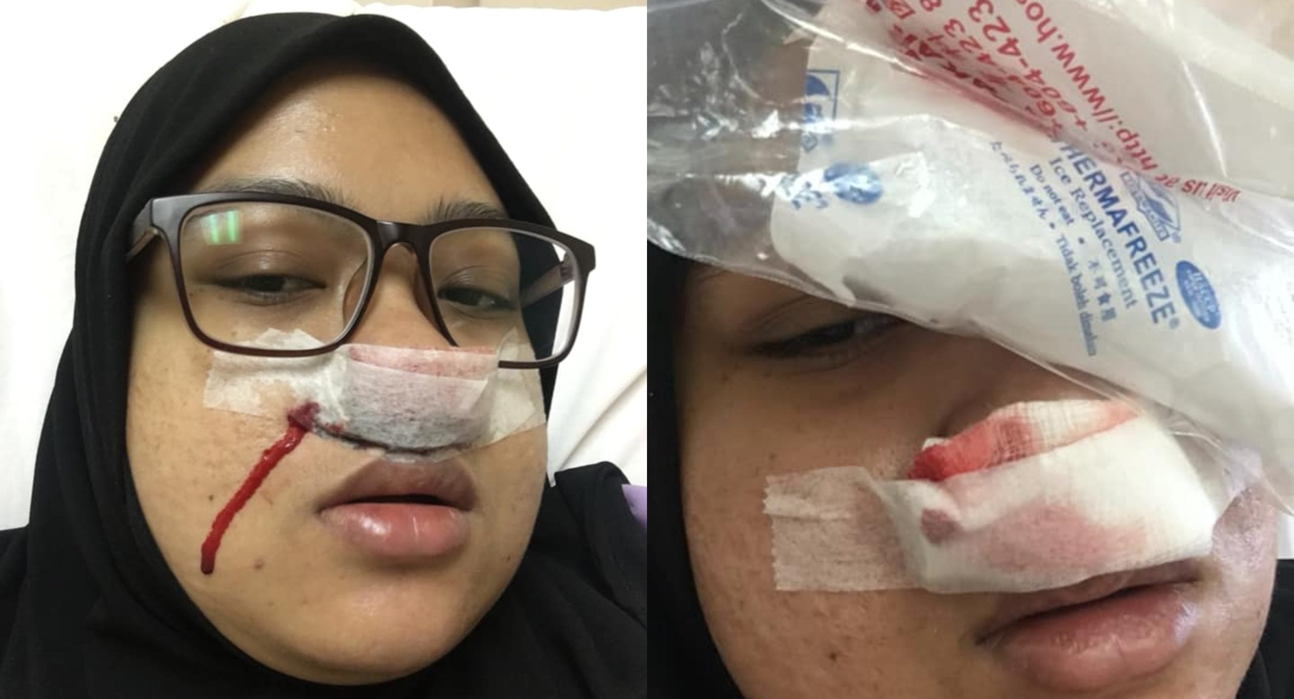 ‘Bersin Pagi-Pagi, Pening Kepala’ – Wanita Jalani Pembedahan Resdung Selepas Hilang Deria Rasa & Bau