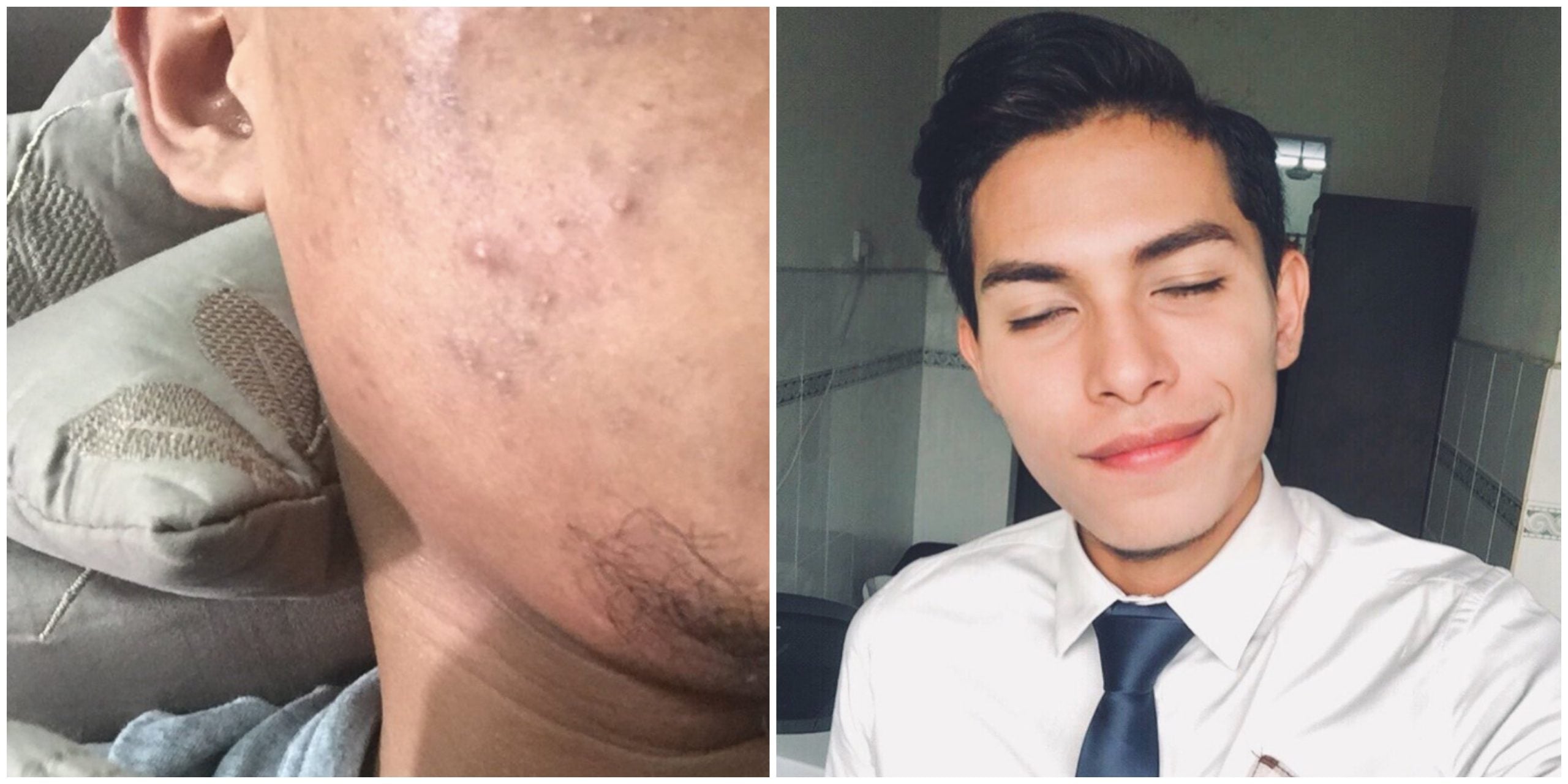 Dulu Picit Jerawat Sampai Terkeluar Kena Cermin, Kini Kulit Muka Lelaki Ini Jadi Licin. Apa Rahsianya?
