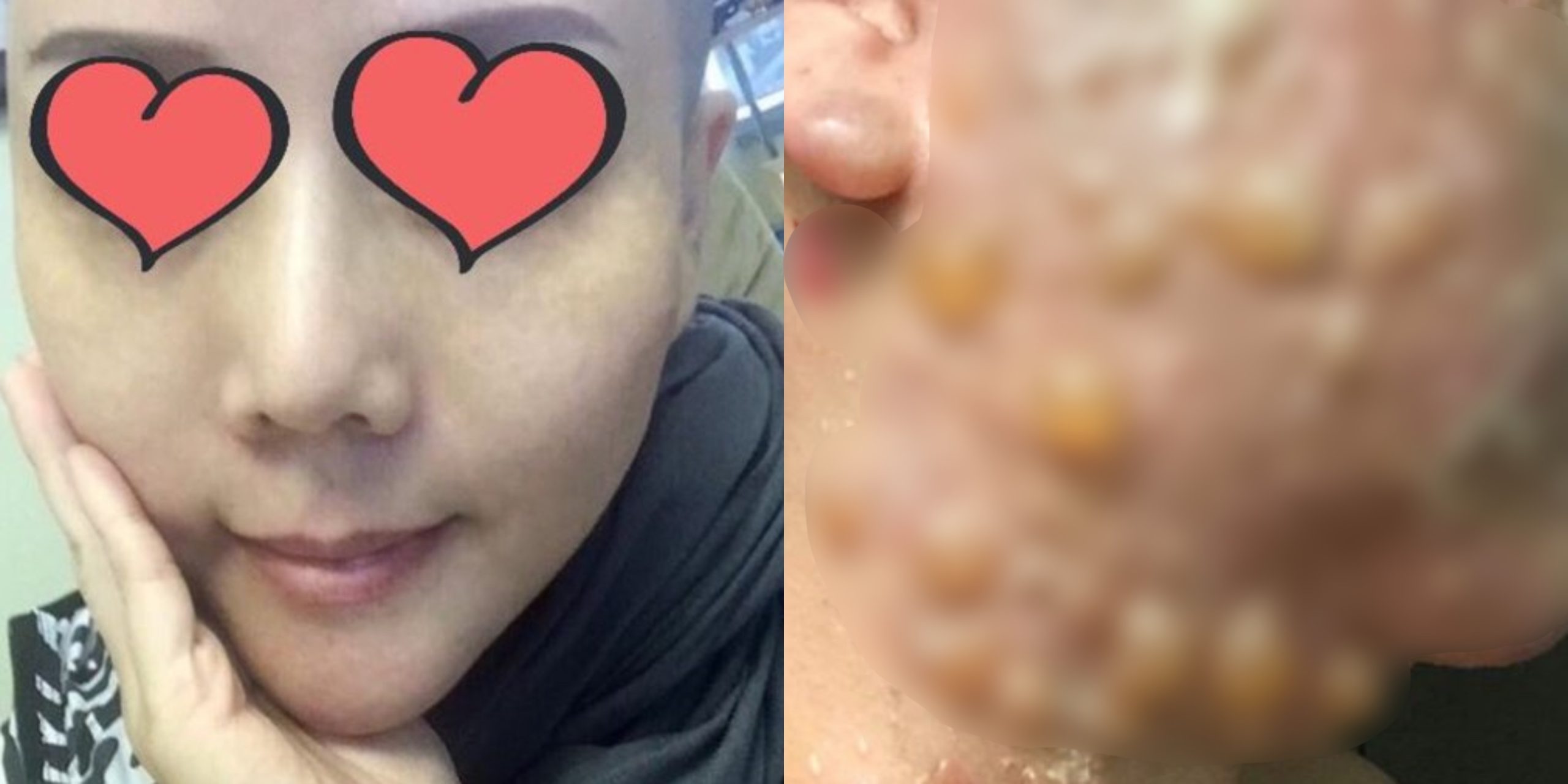 Padah Buat Pembedahan Plastik, Wajah Wanita Ini Melecur Tahap Dua. Ngeri!