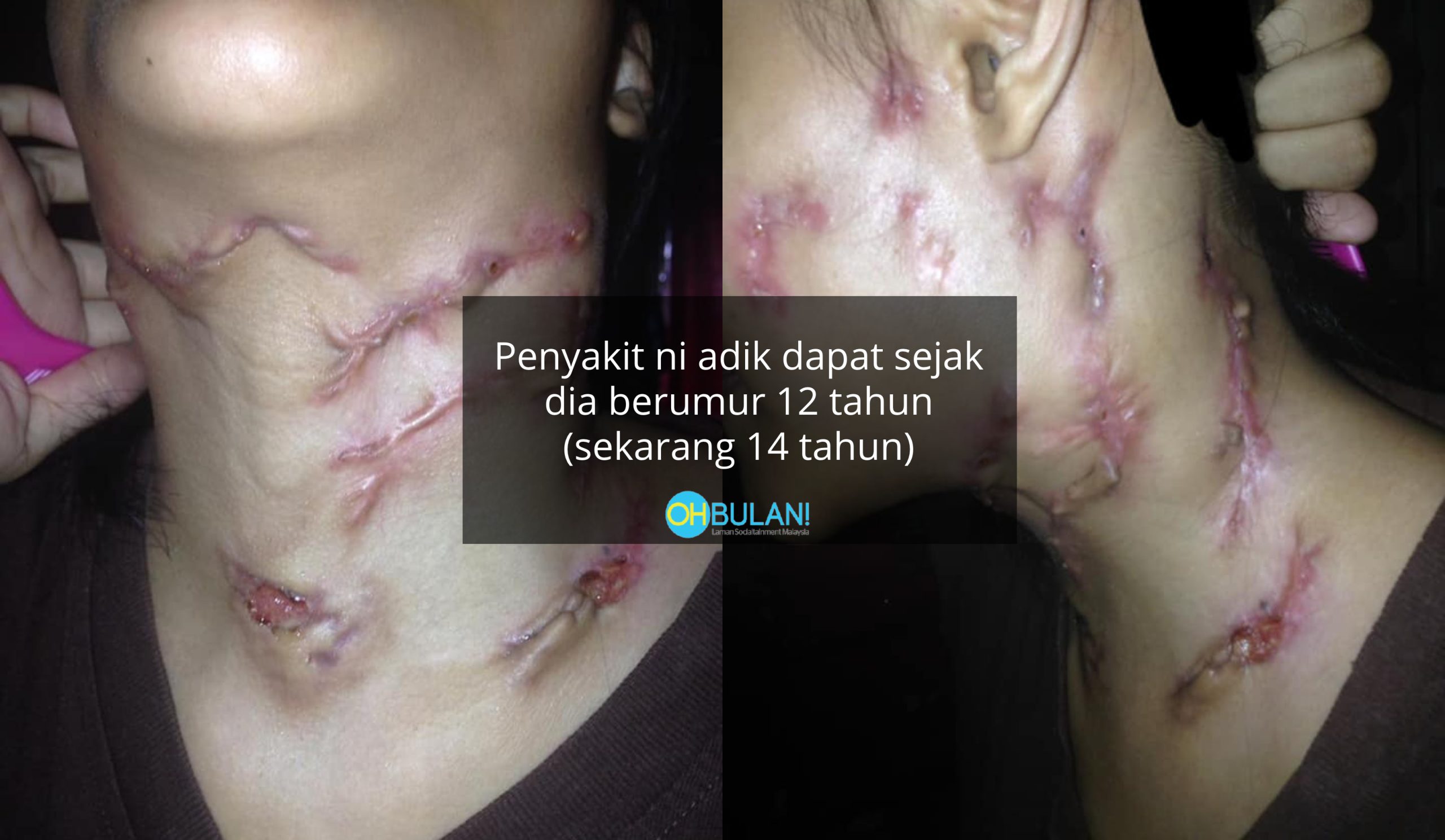 Merebak Di Kawasan Leher & Akan Meletup, Gadis Buntu Adik Hidap Penyakit Misteri Sudah 2 Tahun