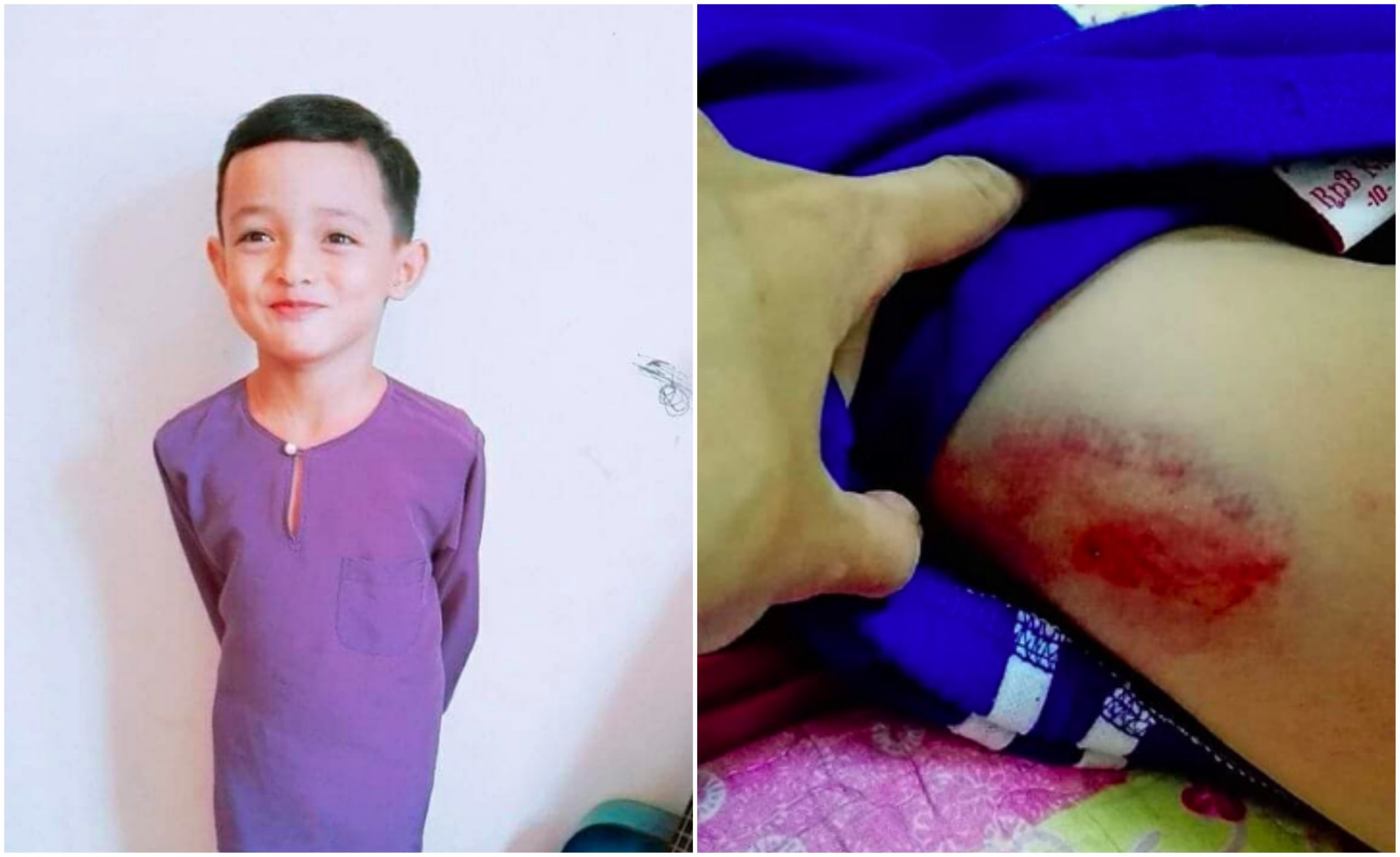 Balik Sekolah Dengan Kesan Lebam & Bengkak, Jawapan Anak 7 Tahun Ini Buat Ibu Luluh