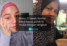 ‘Muka Hitam, Hidung Kembang’ – Hanya Wanita Mengandung Je Pernah Alami ‘Derita’ Ini