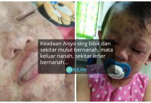 ‘Bibir, Mulut, Mata & Sekitar Leher Bernanah’ – Keadaan Terkini Adik Aisyah Yang Diculik Ketika Sahur