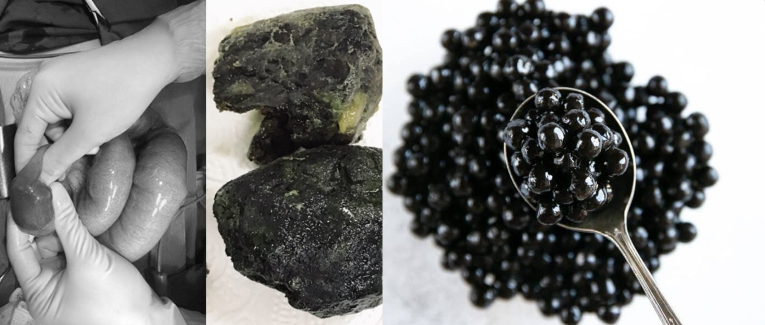 Ketagih Bubble Tea, Usus Lelaki Ini Tersumbat ‘Ketulan Hitam’ & Terpaksa Dibedah