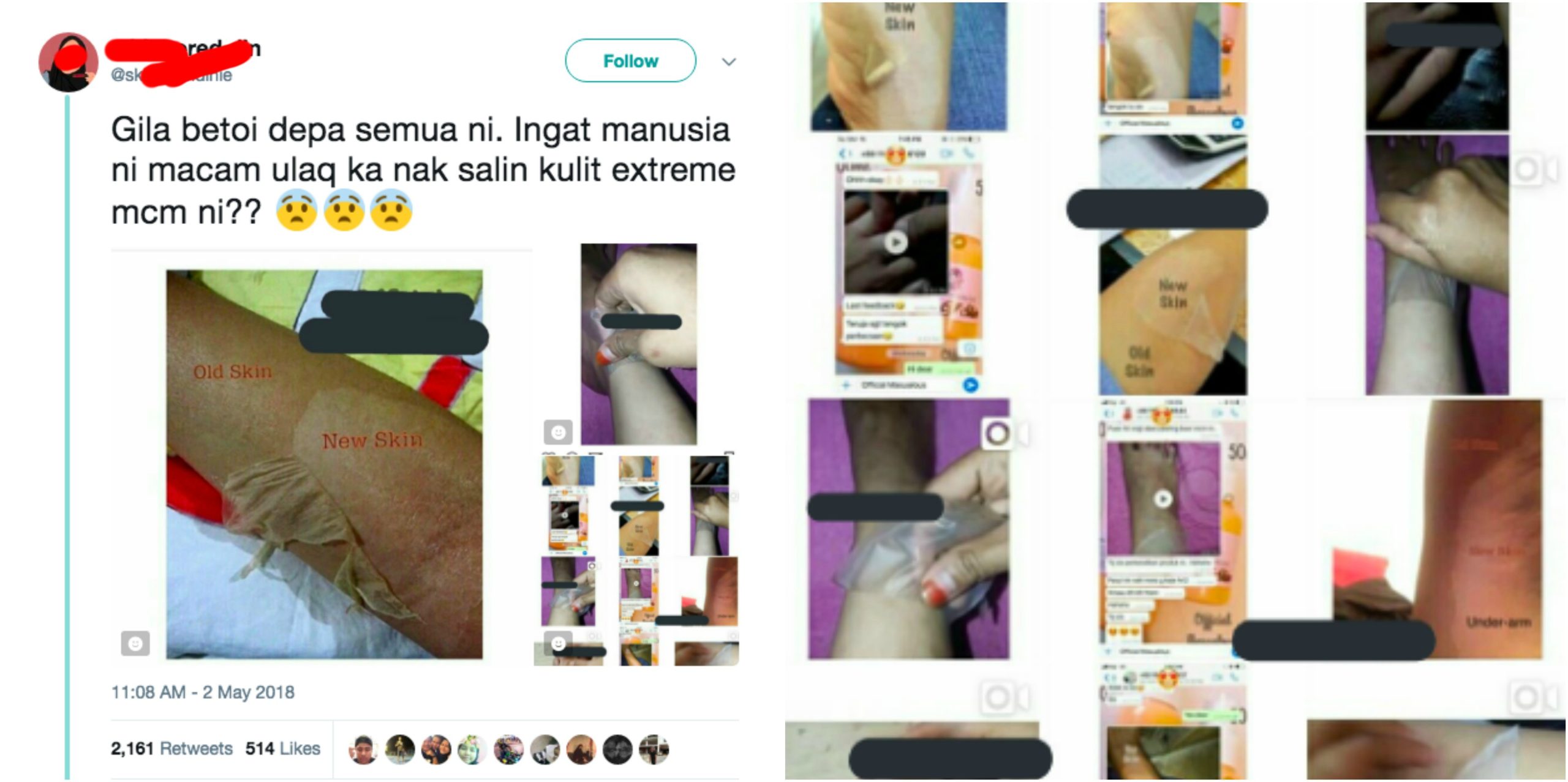 Ingat Ular Ke Boleh Tukar Kulit- Gadis Dedah Produk ‘Skin Peeling’ Di Instagram.. Tengok Pun Rasa Pedih