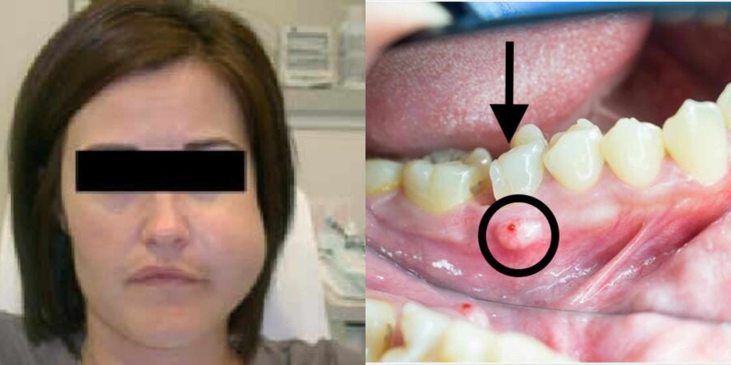 Jangkitan Kuman Sehingga Bernanah, Doktor Kongsi Punca & Sebab Bengkak Muka Akibat Sakit Gigi