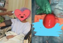 Gara-Gara Terlalu Obses Jamu & Kolagen, Gadis Ini Jalani Pembedahan Buang Fibroid 7cm