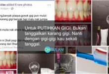 ‘Bodoh Betul Petua..’ – Tips Putihkan Gigi Cara Natural, Doktor Selar Tindakan Individu Ini