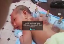 Viral Video Bekam Bayi Undang Kemarahan Netizen, Ini Penjelasan Doktor
