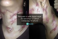 Merebak Di Kawasan Leher & Akan Meletup, Gadis Buntu Adik Hidap Penyakit Misteri Sudah 2 Tahun