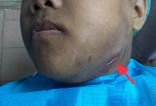 Doktor Kongsi Pengalaman Rawat Pesakit Sakit Gigi Sehingga Bengkak Muka & Bernanah