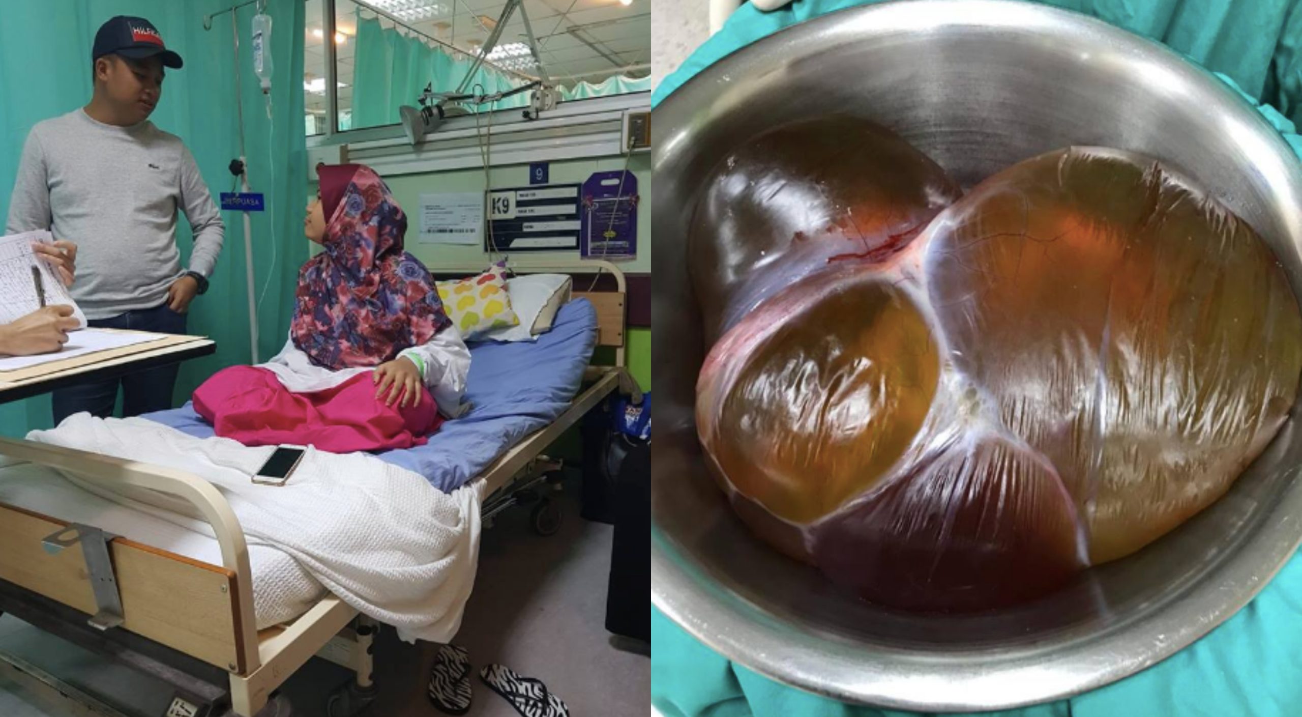 ‘Haid Tidak Teratur, Berat Badan Bertambah’ – Wanita Ini Kongsi Pengalaman Kandung ‘Kantung Cecair’