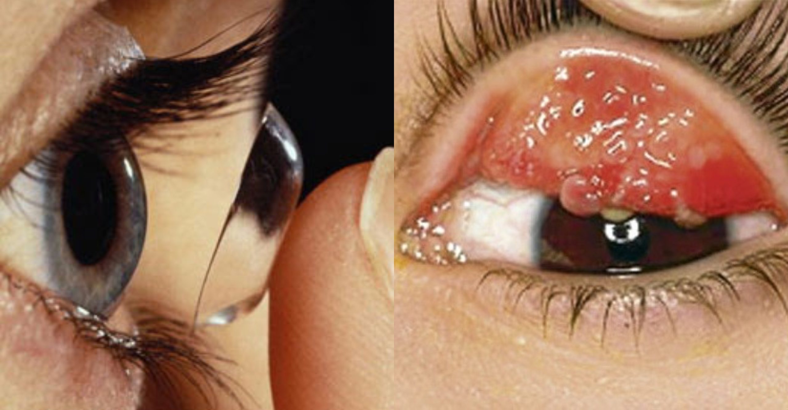 Perlu Ke Cuci? Doktor Jelaskan Kepentingan & Cara Betul Jaga Contact Lens