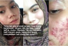 Dulu Muka Berjerawat & Rosak Teruk – Gadis Ini Kongsi Perkara Penting Korang Perlu Jaga Elak Jerawat