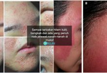 ‘Ambil Yogurt Lepas Tu Campur Timun La..’ – Kulit Terbakar & Jerawat Bernanah Akibat Skincare DIY, Bahaya!