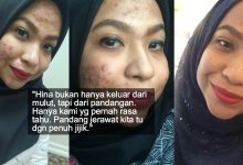 Gelilah Tengok Muka Kau! – Lagi Kisah Dihina & Diperli Kerana Muka Penuh Berjerawat