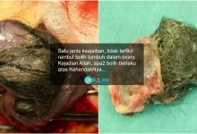 ‘Masih Ada Peluang Hamil..’ – Doktor Kongsi Tips Pemakanan Selepas Pembedahan Cyst