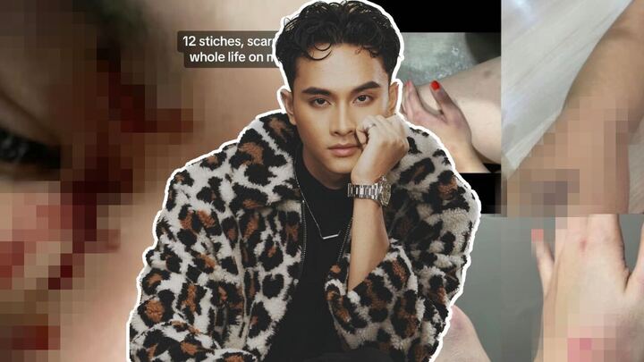 Bekas Kekasih Aniq Suhair Dakwa Dipukul Hingga Cedera & Terima 12 Jahitan Di Muka? Sertakan Bukti & Laporan Kesihatan