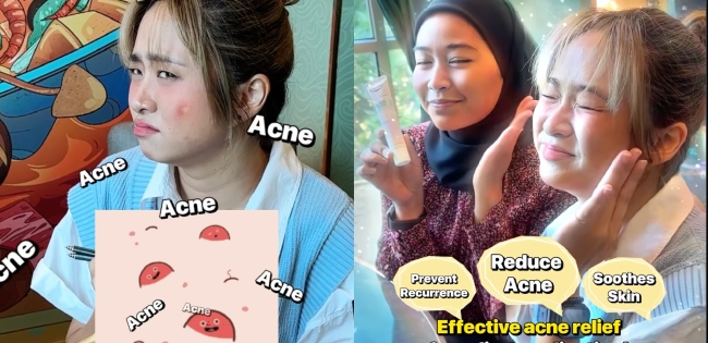 Tak Boleh Stop Makan Pedas Tapi Takut Muka Senang Naik Jerawat? SOS Boleh Tolong Korang!