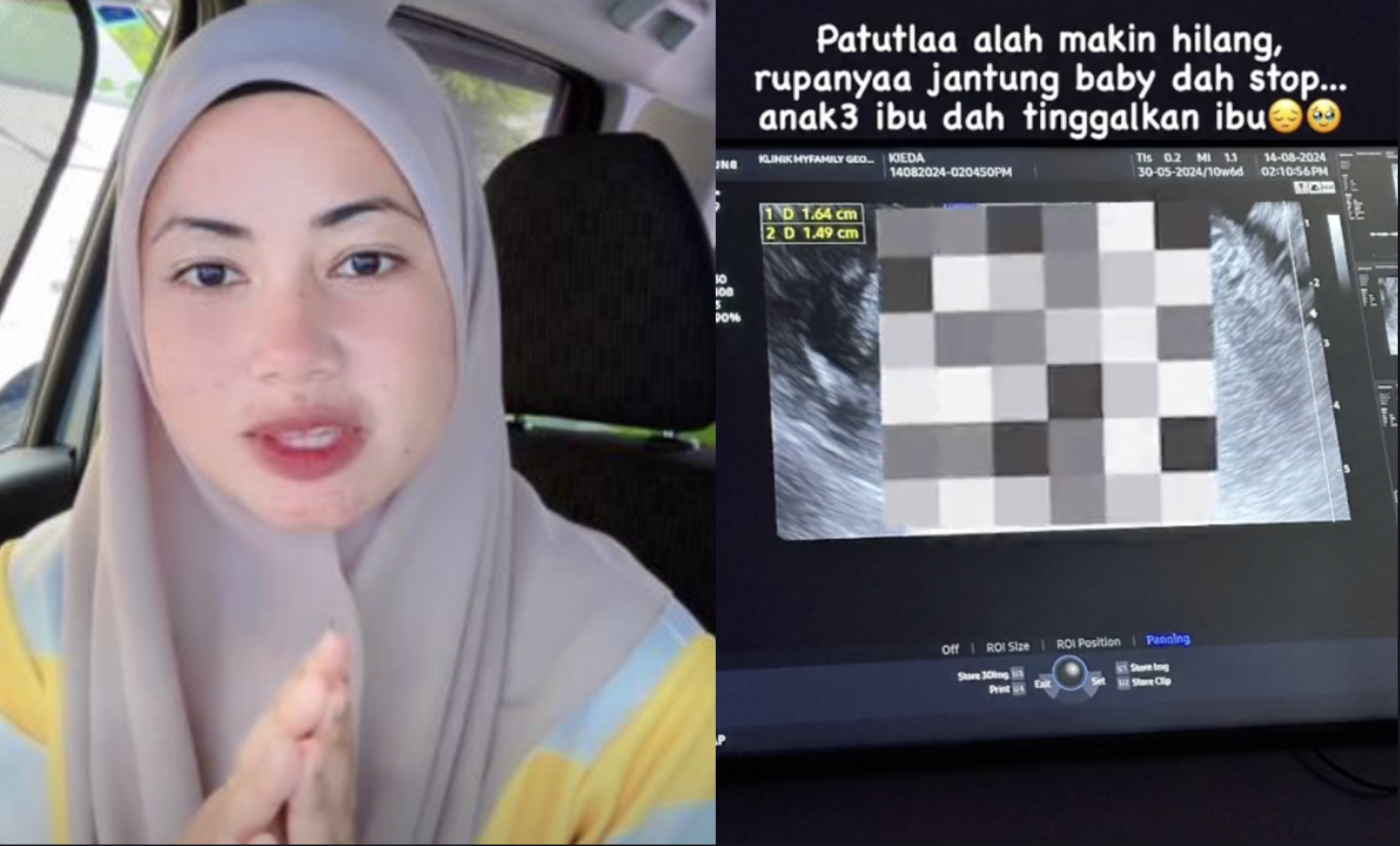 ‘Patutlah Alah Makin Hilang, Rupanya Jantung Baby Dah Stop’ – Kieda Crepe