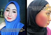 ‘Nanah Sampai Meleleh Keluar’ – Mangsa Produk Merkuri Derita Kulit ‘Breakout’, Siap Beri Izin Suami Kahwin Lain