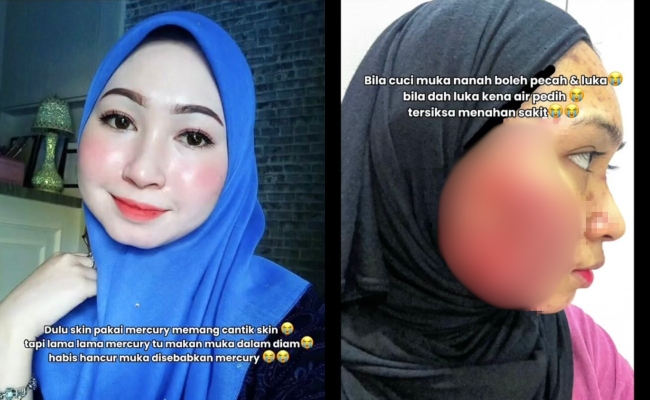 ‘Nanah Sampai Meleleh Keluar’ – Mangsa Produk Merkuri Derita Kulit ‘Breakout’, Siap Beri Izin Suami Kahwin Lain