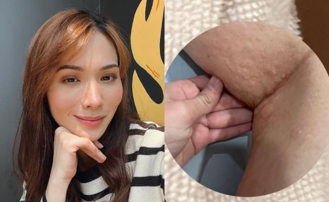 Elvina Mohamad Hairan Badan Tiba-Tiba Naik Gatal, Bibir Jadi Bengkak – ‘Dah Makan Ubat Pun Tak Surut’