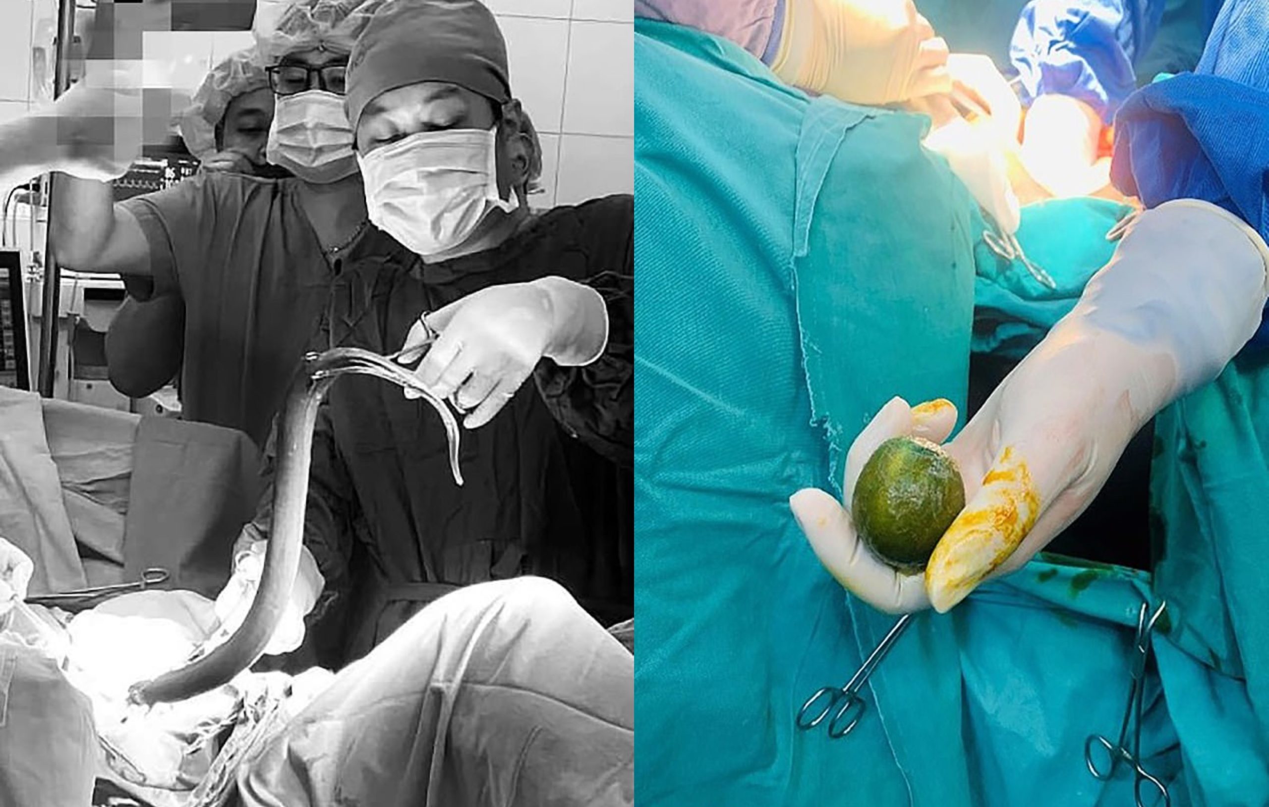 Demi Nafsu Lelaki Sanggup Masukkan Belut Sepanjang 64cm & Sebiji Lemon Ke Dalam Dubur