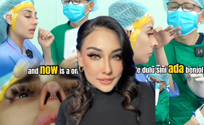 Zarina Anjoulie Gembira Pembedahan Hidung ‘Made In Vietnam’ Berjaya – ‘Sekarang Dah Tak Ada Benjol’