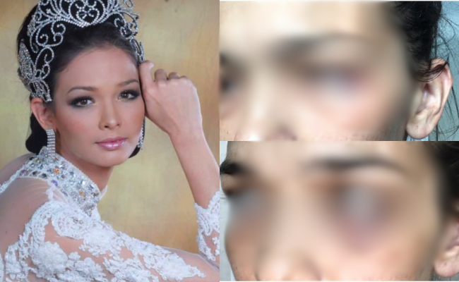 Zahnita Wilson Kongsi Gambar Mata Lebam, Netizen Mula Berteka-Teki – ‘Dia Kena Dera Ke?’