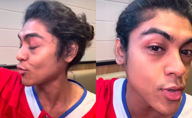 [VIDEO] Agy Kongsi Keadaan Muka Bengkak Selepas Makan Ubat Tahan Sakit – ‘Saya Memang Confirm Alergik’