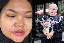 Pempengaruh Amalina Jasmin Dedah Pernah Kena ‘Body Shaming’ & Masalah Muka Berjerawat – ‘Saya Akan Berhabis Dalam RM200 Hingga RM300 Sebulan’