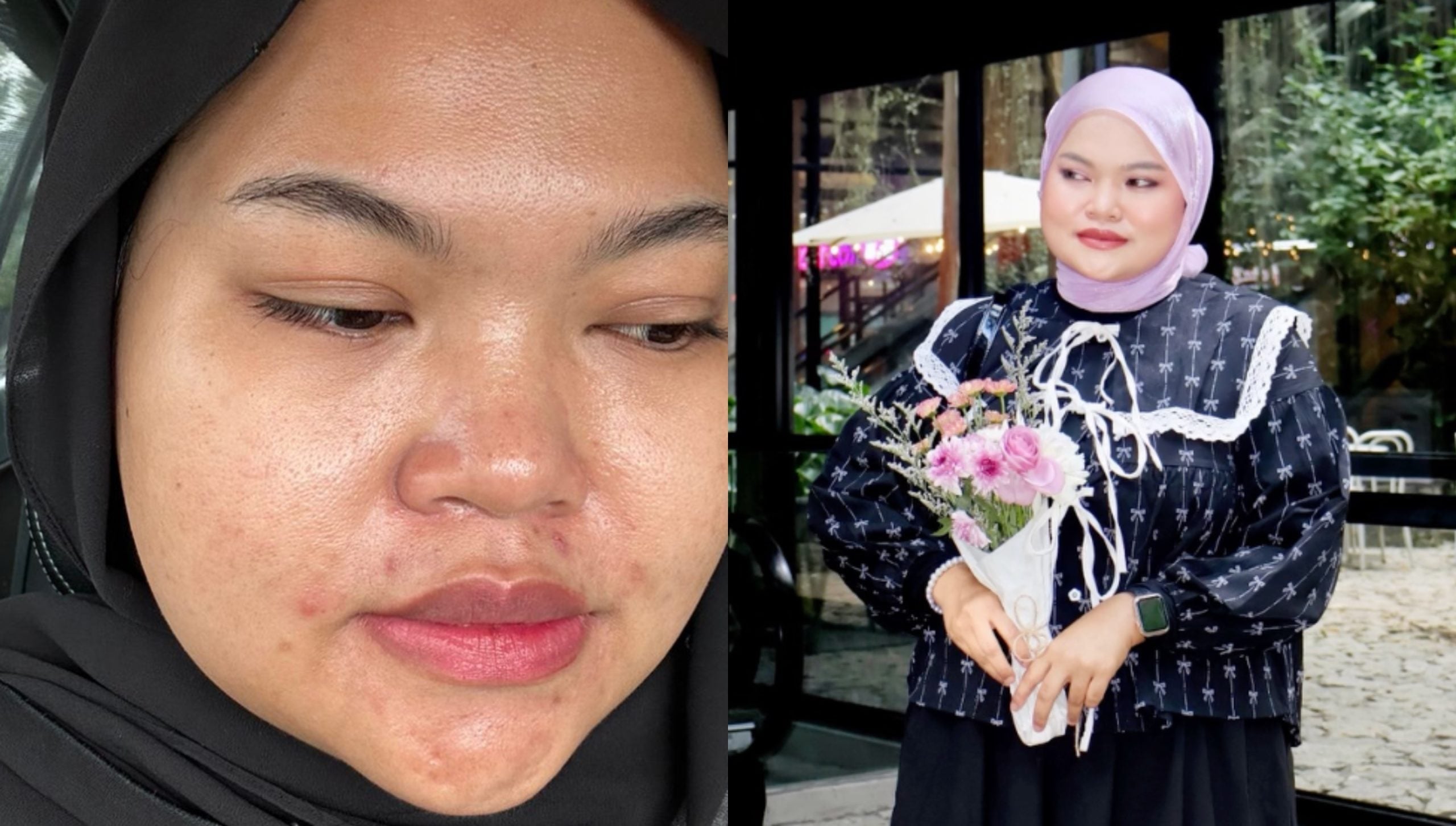 Pempengaruh Amalina Jasmin Dedah Pernah Kena ‘Body Shaming’ & Masalah Muka Berjerawat – ‘Saya Akan Berhabis Dalam RM200 Hingga RM300 Sebulan’