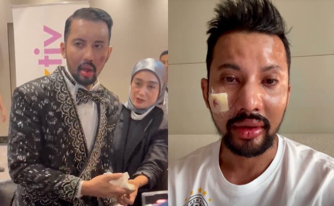 Razmi Akui Hutang Punca Diserang, Dakwa Jurugambar Setuju Terima Bayaran Secara Ansuran – ‘Janganlah Buat Wajah Orang Macam Ini’